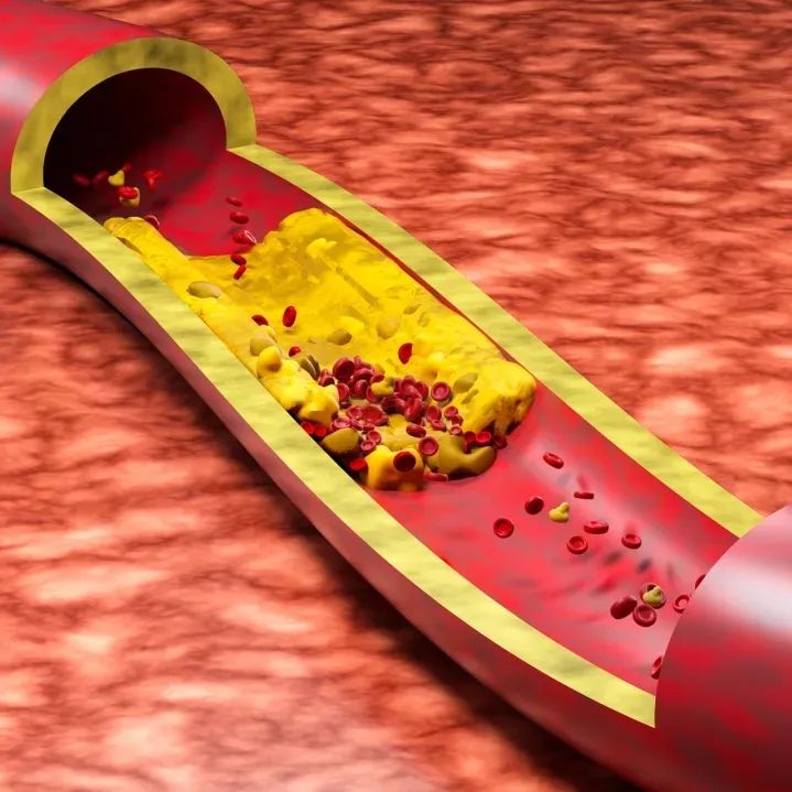 注意了(le)！有(yǒu)這(zhè)6種症狀 ，提醒你(nǐ)該查血脂了(le)